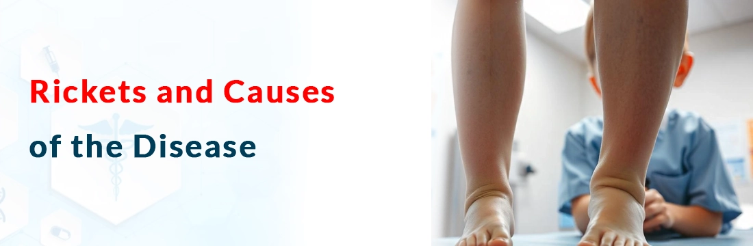  Rickets and Causes of the Disease